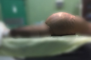 tumor-gigante-de-ovario-en-niña